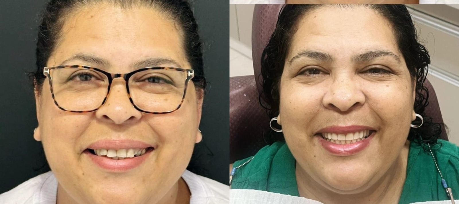 Antes e depois de paciente da Oral Unic Timbó — protocolo de implantes