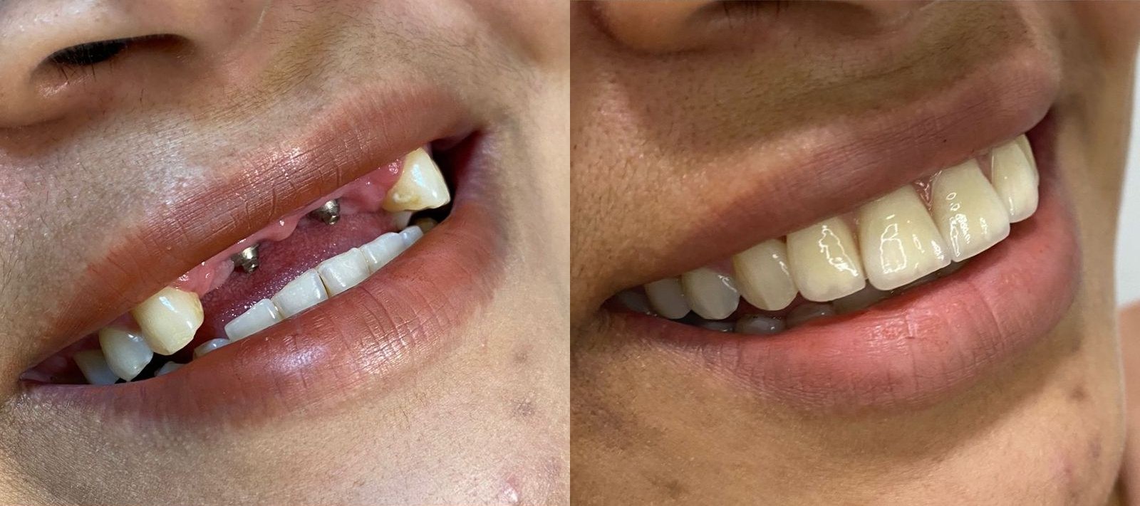 Antes e depois de paciente da Oral Unic Timbó — protocolo de implantes