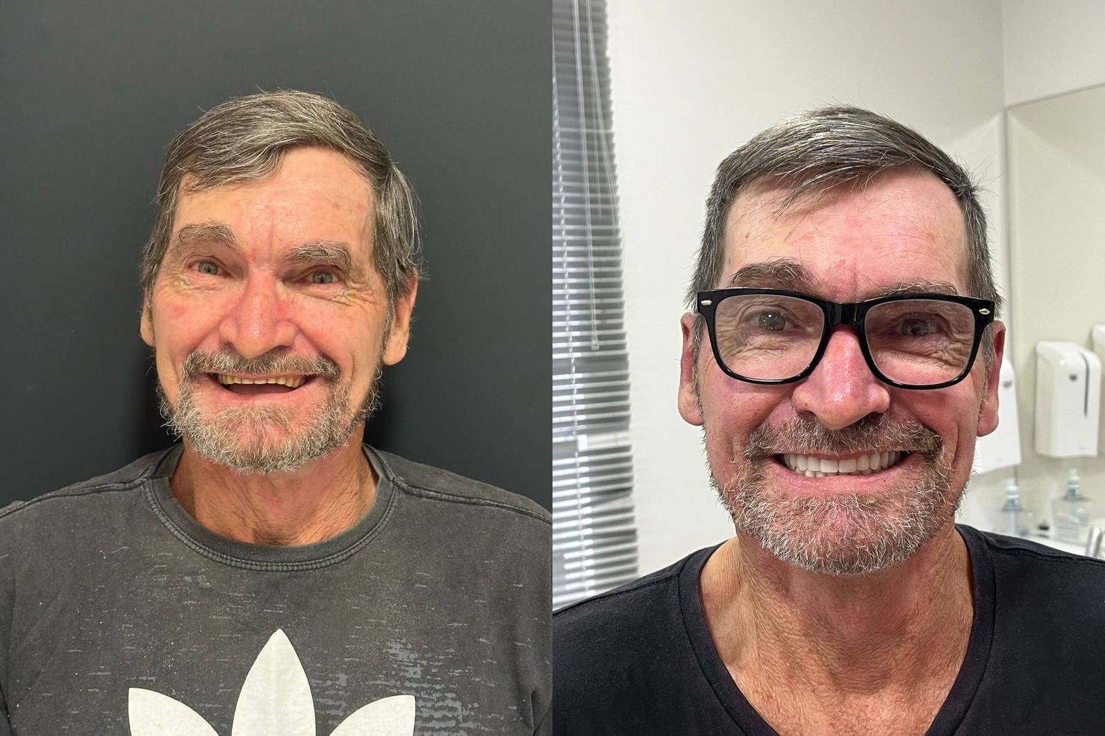 Antes e depois de paciente da Oral Unic Timbó — reabilitação oral